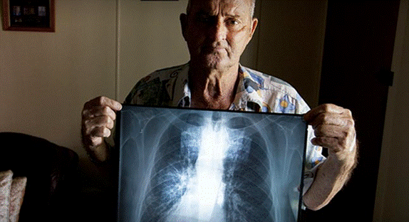 Mr Percy Verrall, who spoke to the committee at its Brisbane hearing on 7 March 2016, holds up an x-ray of his lungs showing the development of CWP